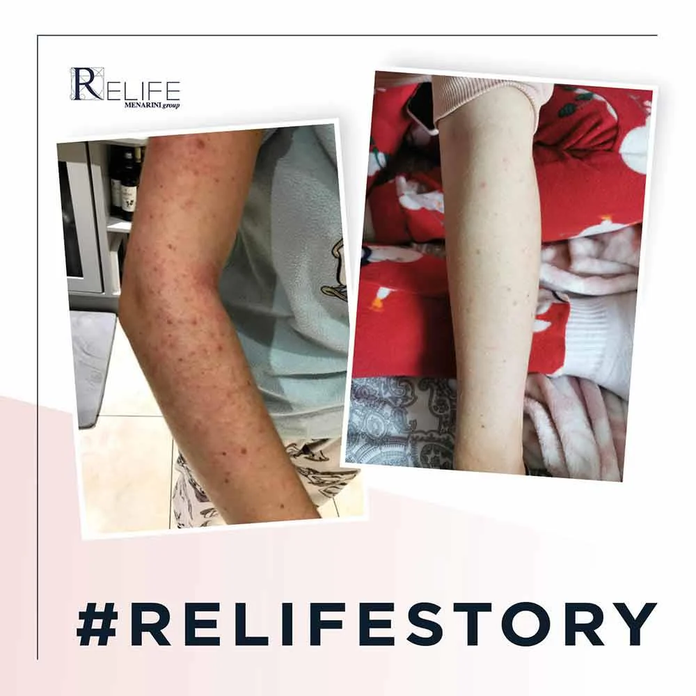 Relife Relizema Cream 40ml - Image 2