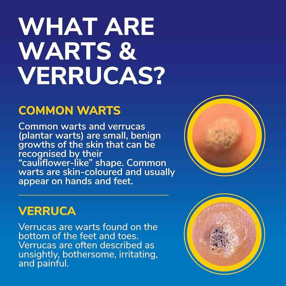 Scholl Freeze Away MAX Verruca & Wart Remover - Image 5